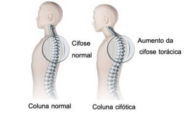 Desvios de coluna vertebral