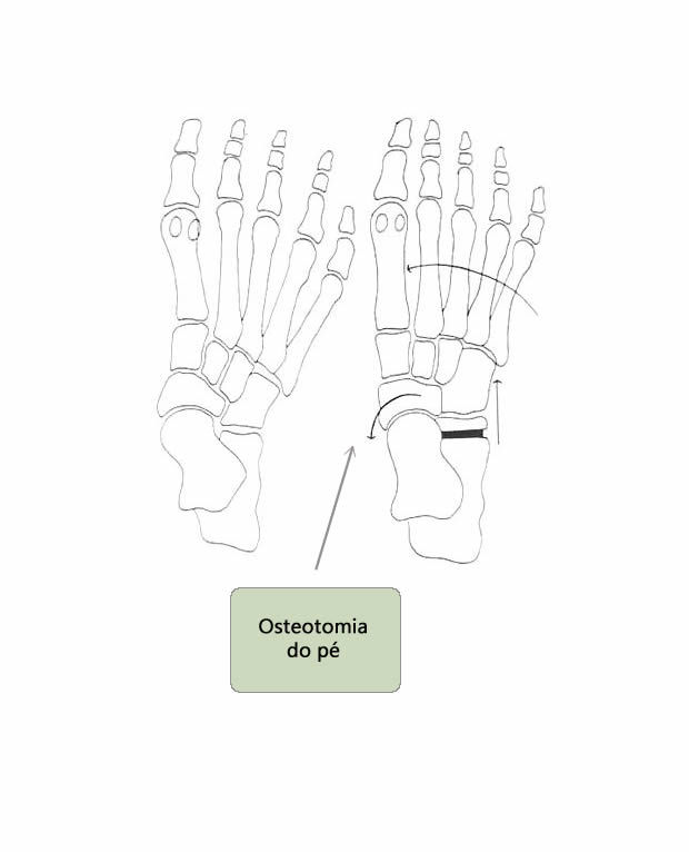 Osteotomia do pé